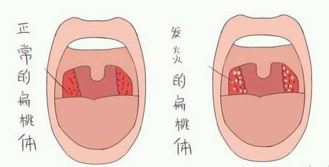 扁桃体一个月发炎三次