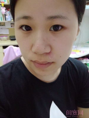痘痘贴好吗