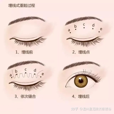 全切埋线哪个好