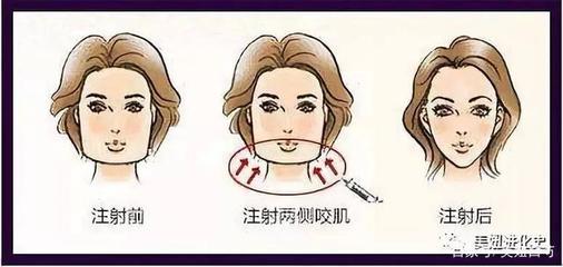 瘦脸针为什么会凹陷