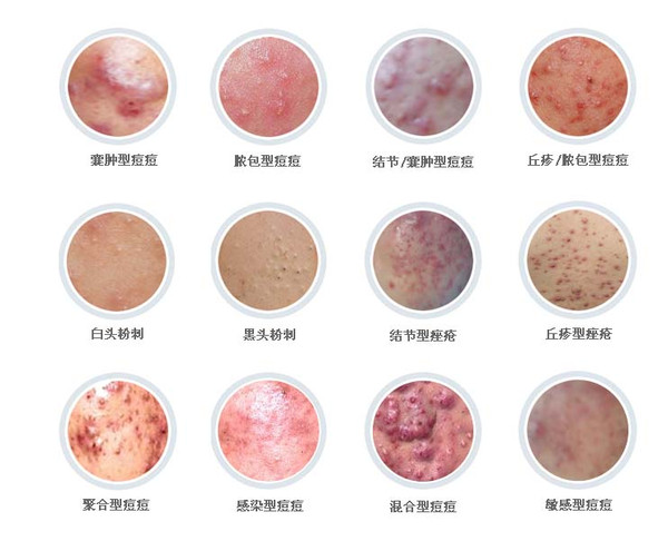 粉瘤和痘痘的区别