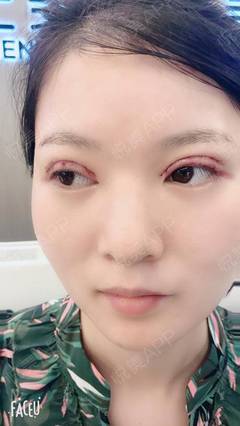 全切双眼皮多久能上班