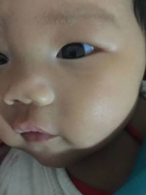 两岁宝宝眼皮肿怎么回事