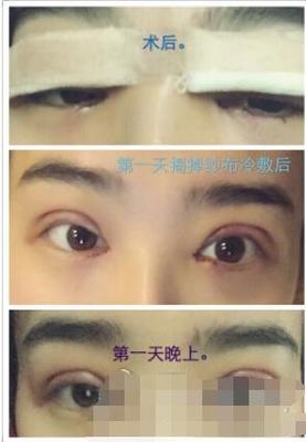 美莱做的双眼皮好吗