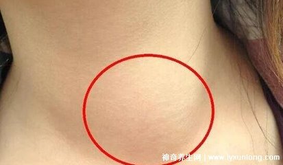 嗓子一侧疼是怎么回事