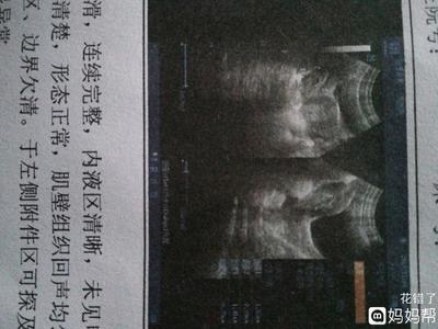 排卵期囊肿
