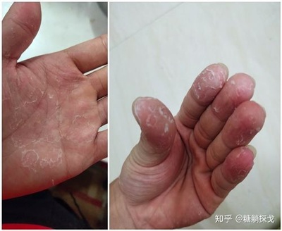手破皮是怎么回事
