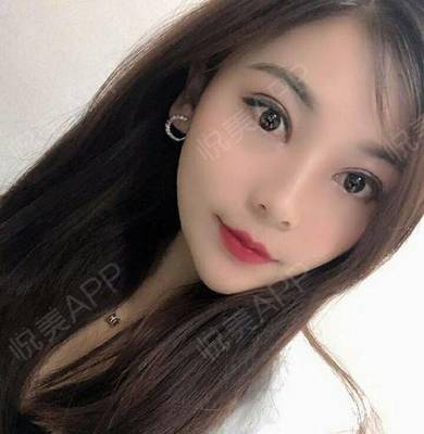 双眼皮有几种做法