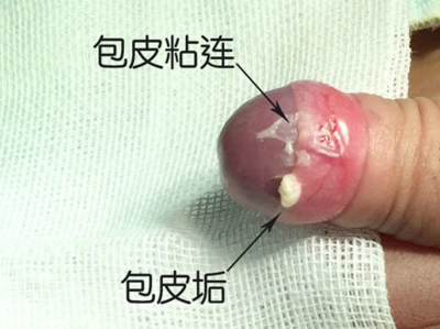 包皮垢是怎么回事