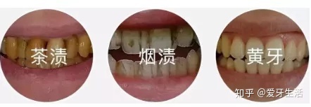 吸烟牙黄洗牙能变白吗