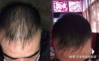 男生爱掉头发是怎么回事