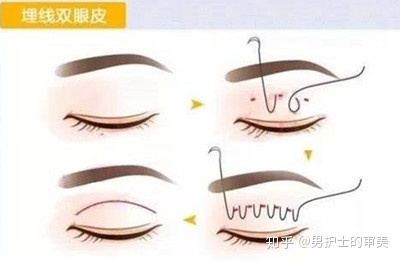 揉眼睛变双眼皮