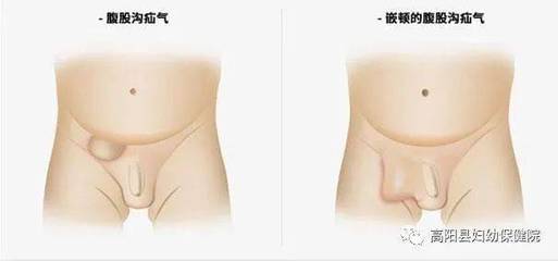 新生儿疝气