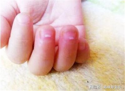宝宝指甲上有白点是什么原因