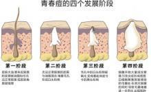 长痘痘的四个阶段