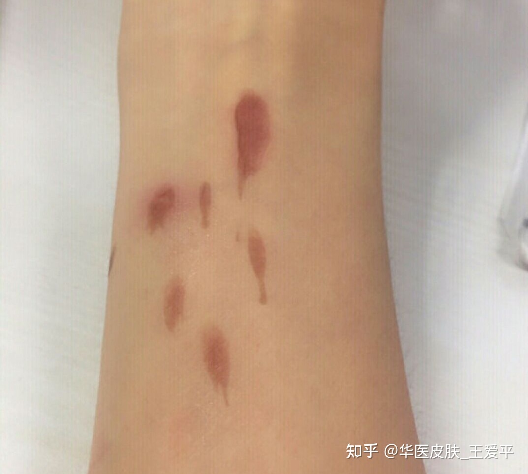 如何去除烫伤的疤痕