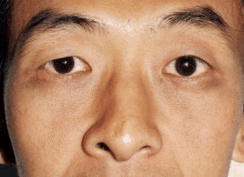 猪鼻面相