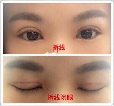全切双眼皮拆线后