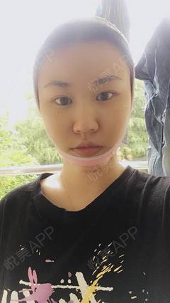 黄金微雕瘦脸