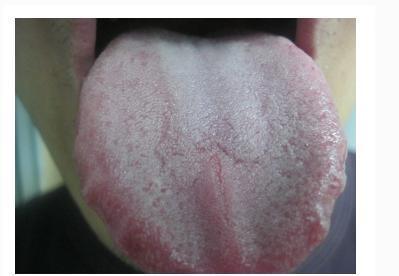舌苔白厚腻是怎么回事