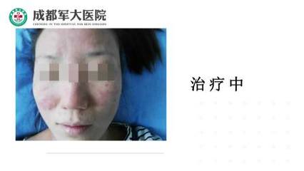 成都皮炎所治痘痘