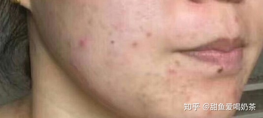 女孩子脸上有痘痘