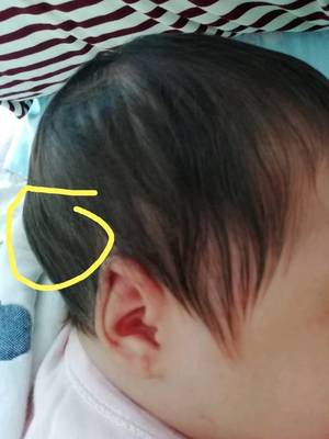 宝宝左侧头骨凸起图片