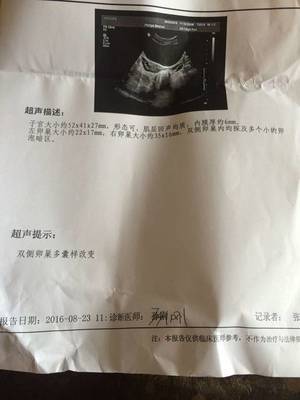 双侧卵巢多囊会怀孕吗
