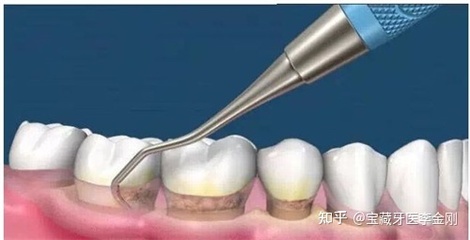 洗牙用什么工具