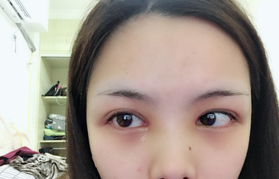 双眼皮切口处发红