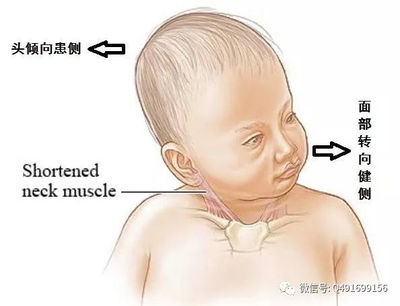 新生儿斜颈