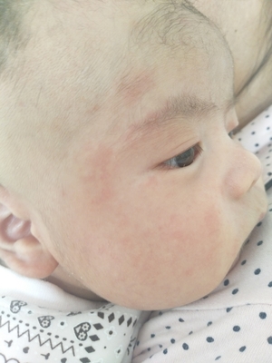 6个月宝宝出疹子症状