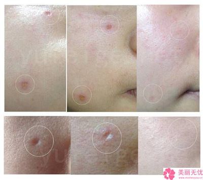 用激光去痘痘多少钱
