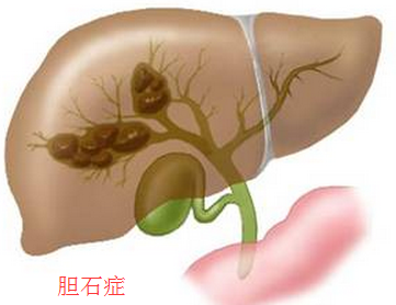 胆管结石怎么治疗好