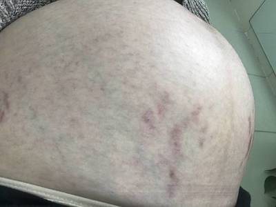 怀孕几个月开始长妊娠纹