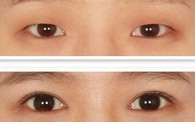 怀孕了能做双眼皮吗