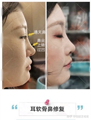 耳软骨隆鼻是永久的吗