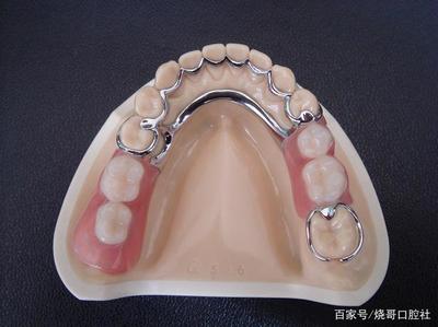 烤瓷牙怎么装上去的