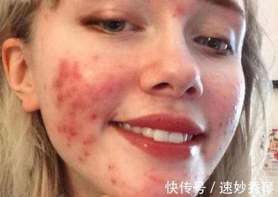 痘痘为什么反复起