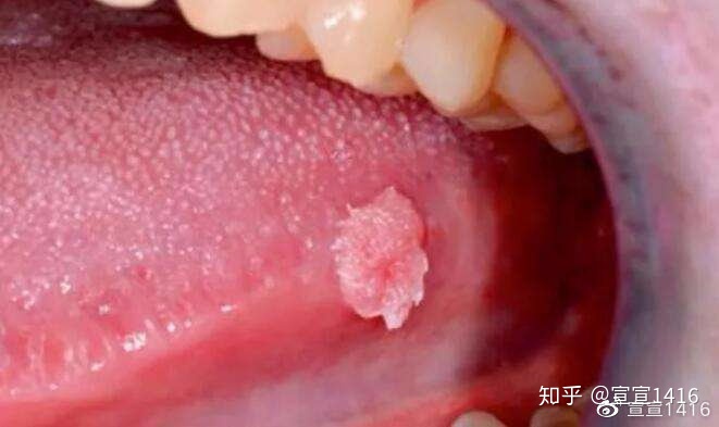 什么食物治痘痘的
