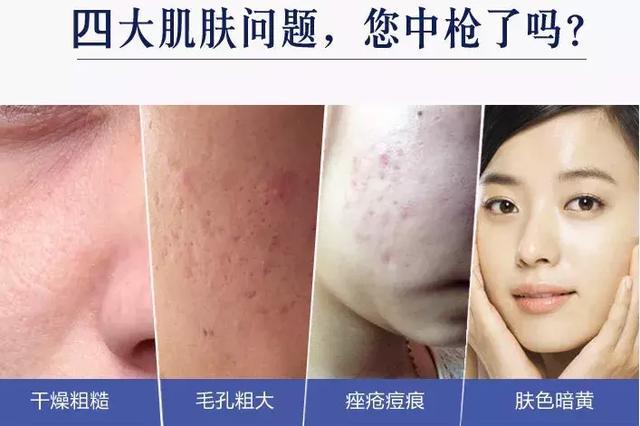 脸颊长闭口痘痘的原因分析