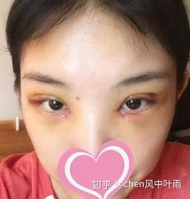 双眼皮疤痕多久才淡化