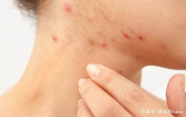 为什么脸上有痘痘男士