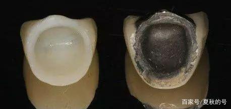 钴铬合金烤瓷牙做核磁共振可以吗