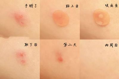 挤痘痘组织液挤很多