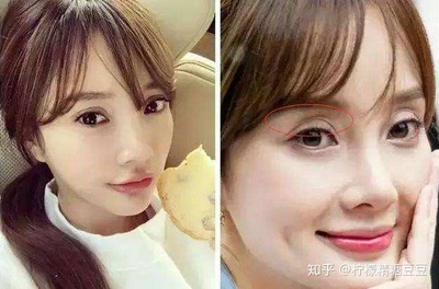 割了双眼皮后特后悔