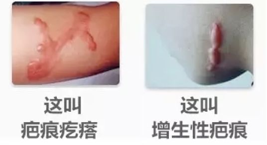 怎么确定是不是疤痕体质
