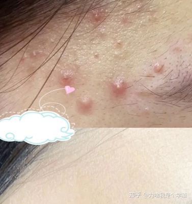 两鬓总是长痘痘是什么原因