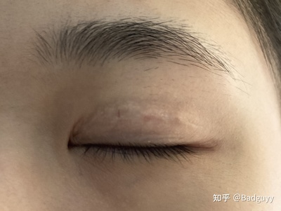做双眼皮打麻药疼不疼