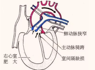 动脉扩张怎么治疗
